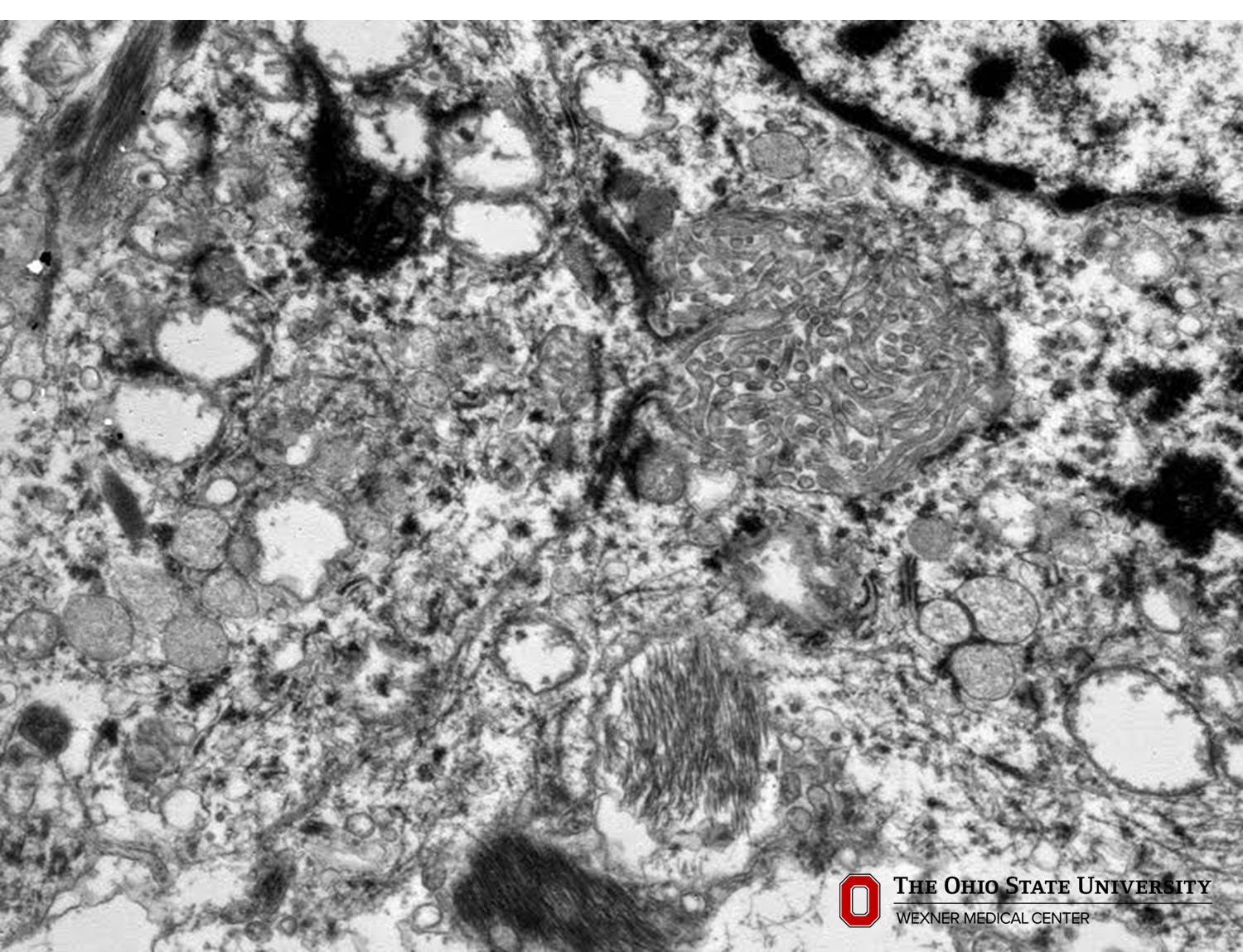 Microscopic image possibly detecting cancerous areas in human tissue