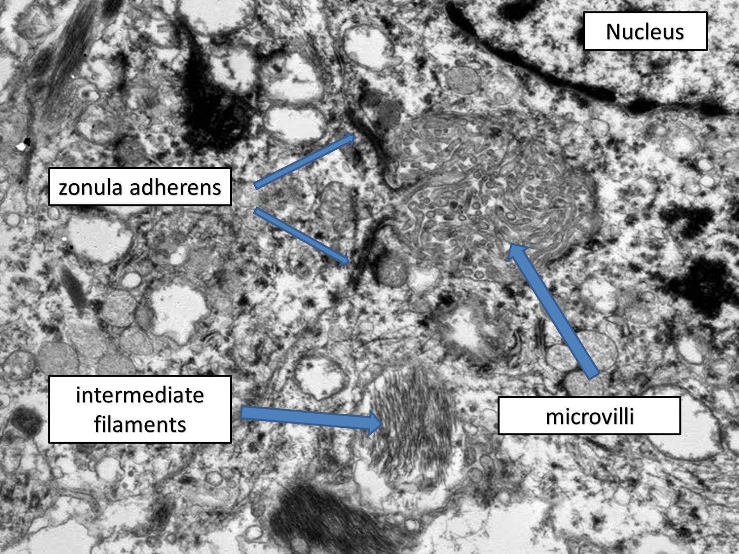 Microscopic image possibly detecting cancerous areas in human tissue