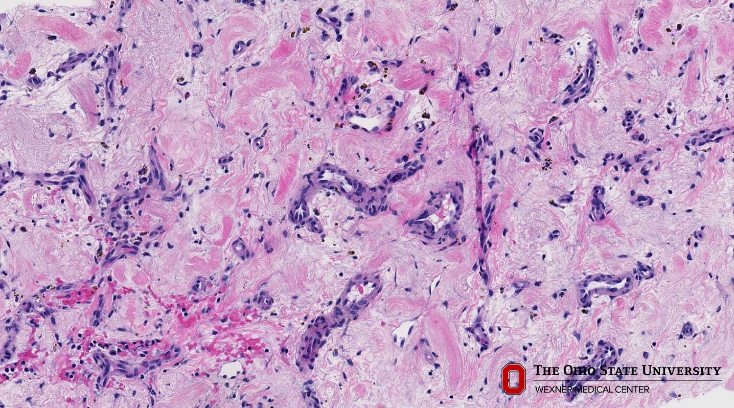 Microscopic image possibly detecting cancerous areas in human tissue