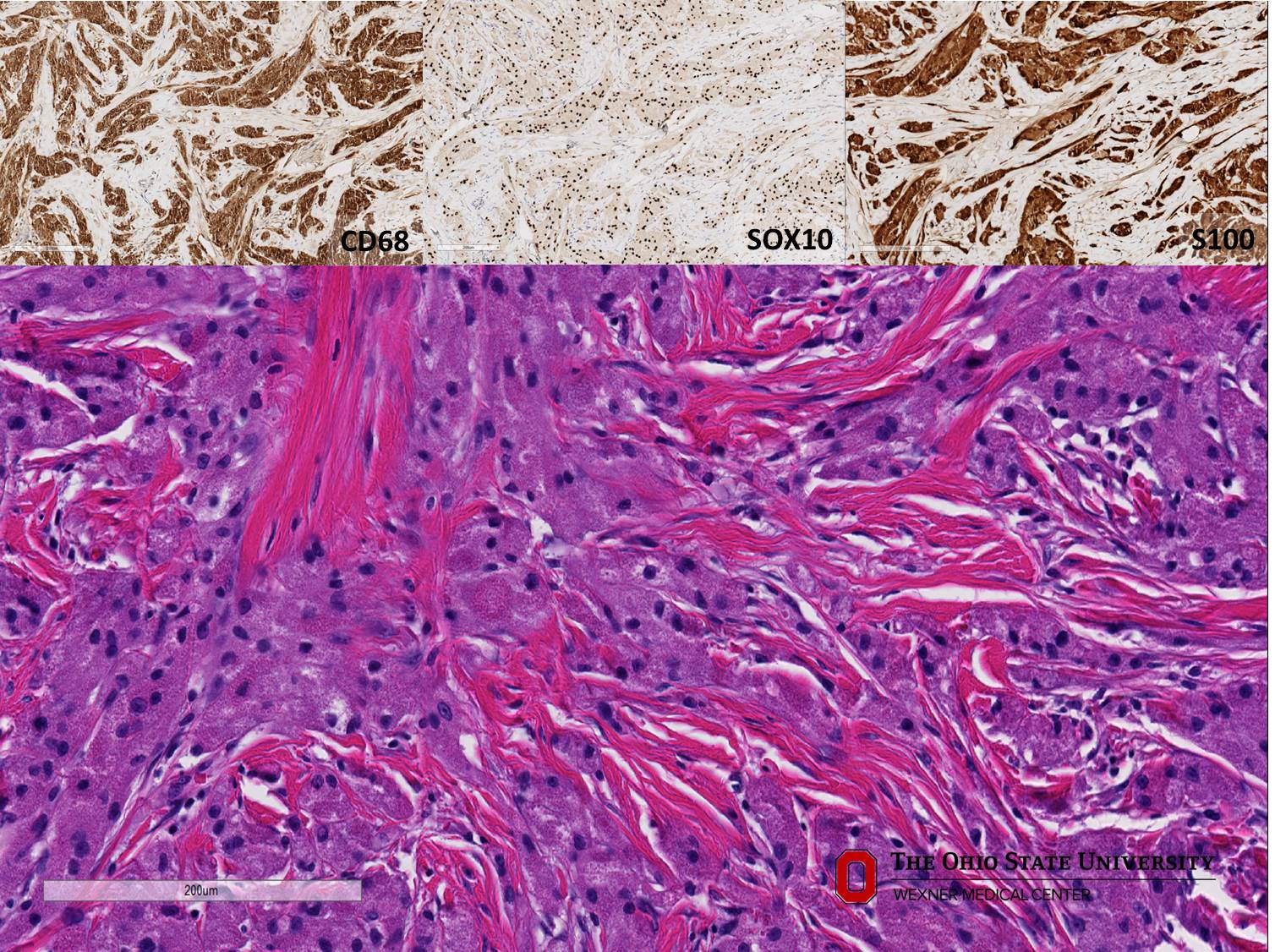 Microscopic image possibly detecting cancerous areas in human tissue