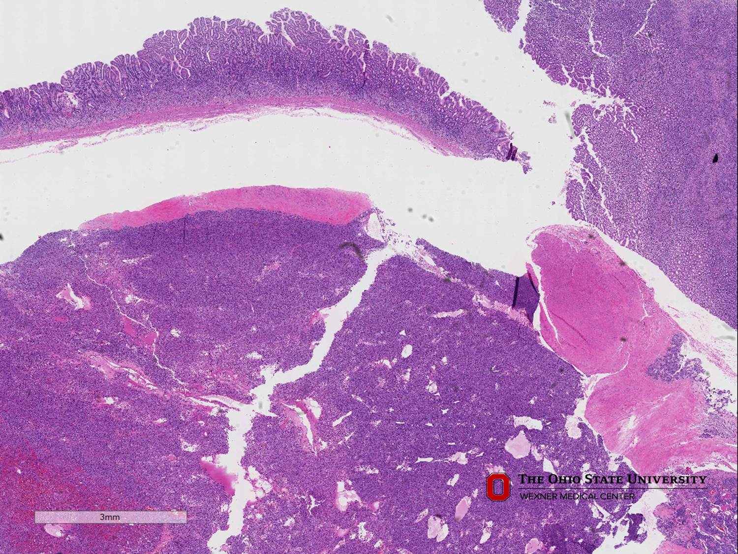 Microscopic image possibly detecting cancerous areas in human tissue