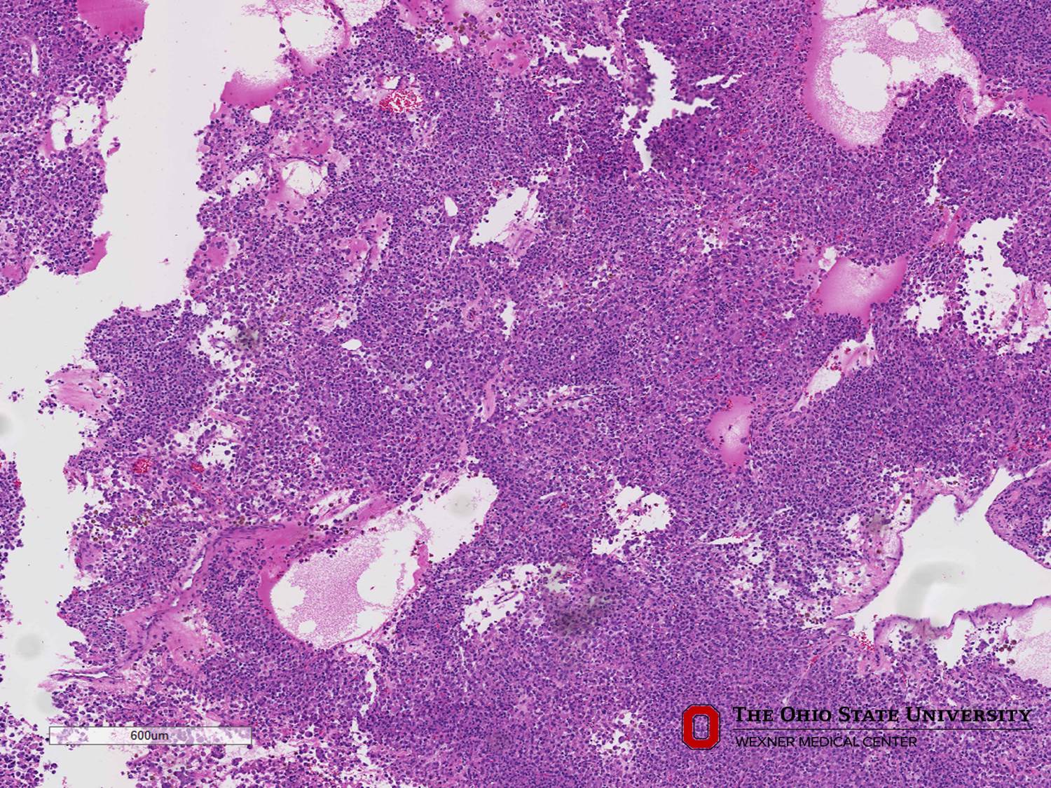 Microscopic image possibly detecting cancerous areas in human tissue