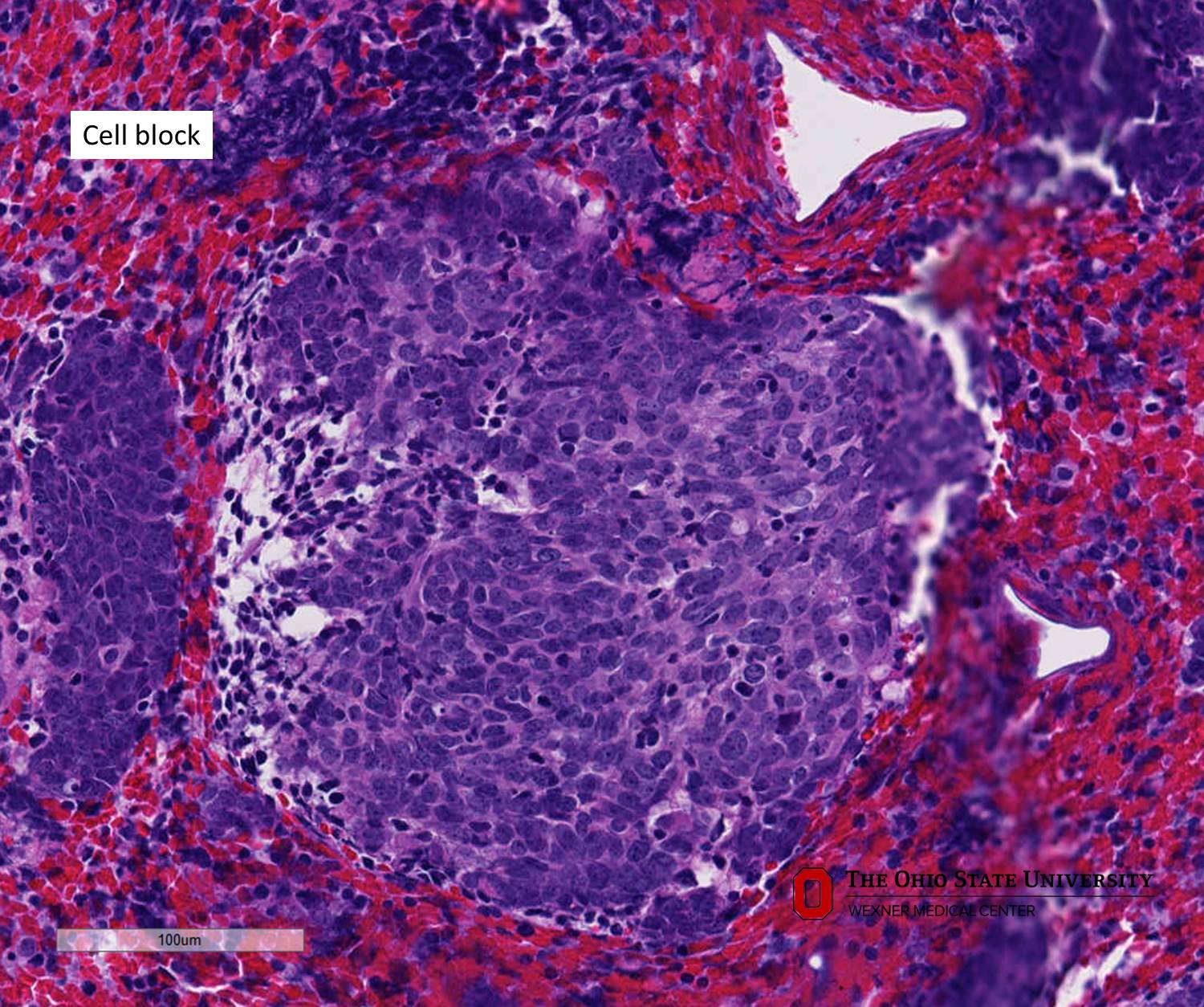 Microscopic image possibly detecting cancerous areas in human tissue