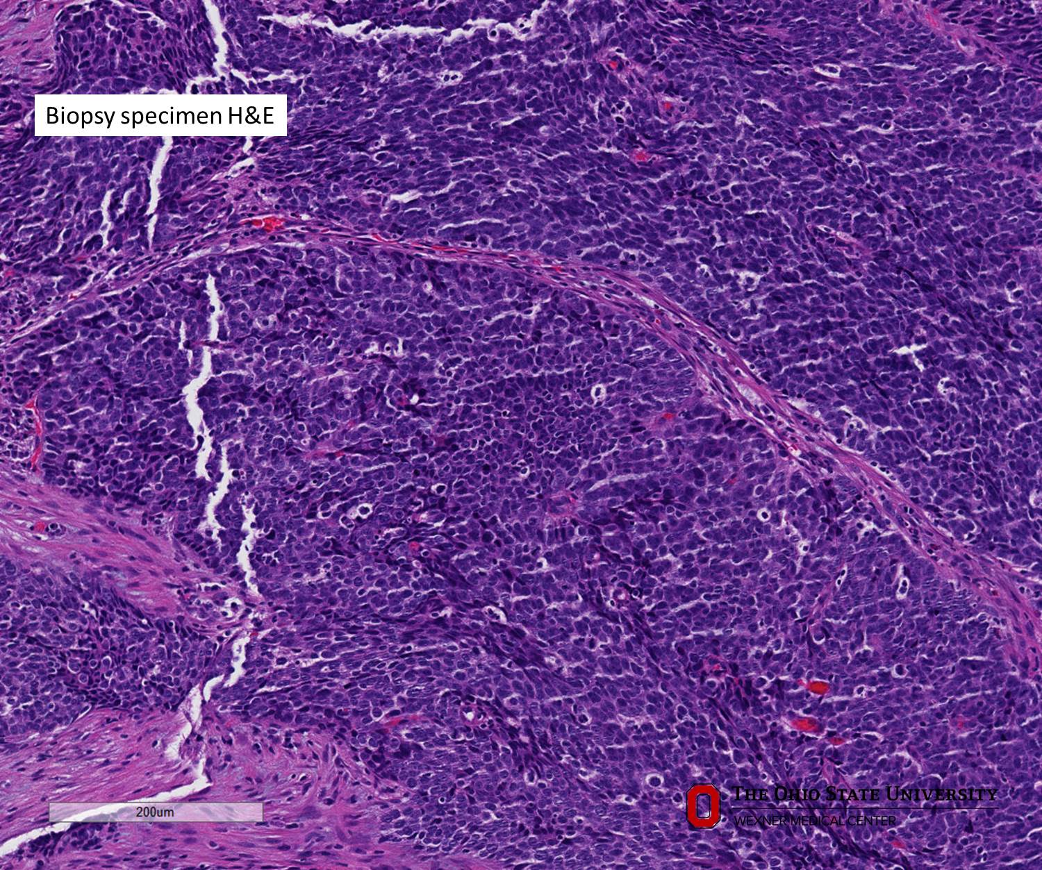 Microscopic image possibly detecting cancerous areas in human tissue