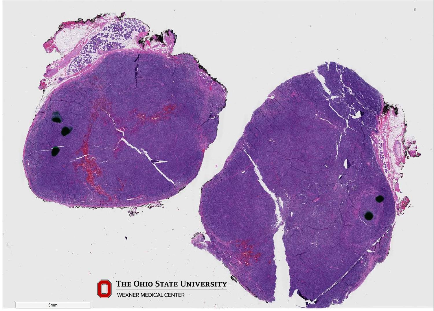 Microscopic image possibly detecting cancerous areas in human tissue