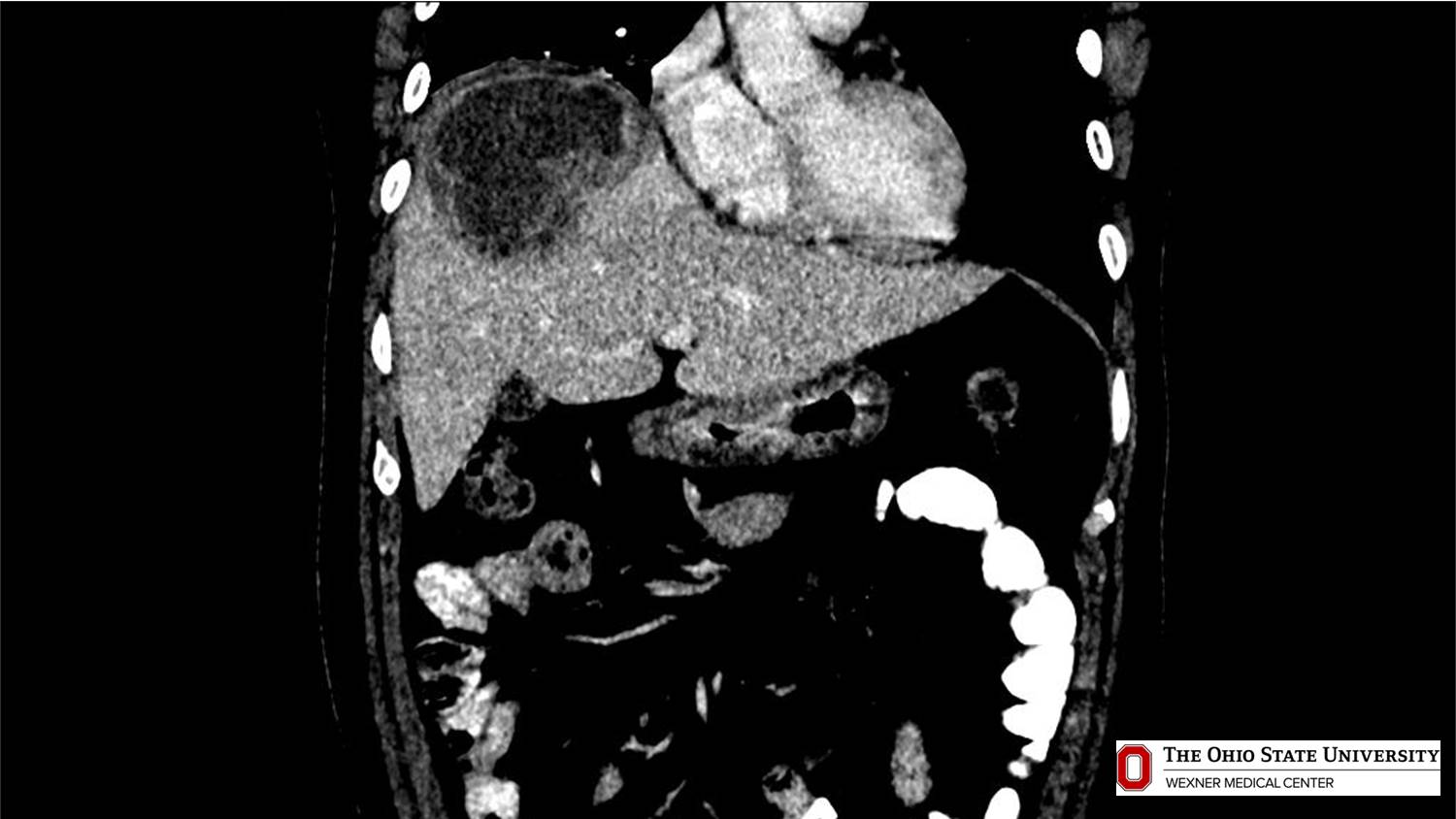 CT scan possibly detecting cancerous areas in human tissue