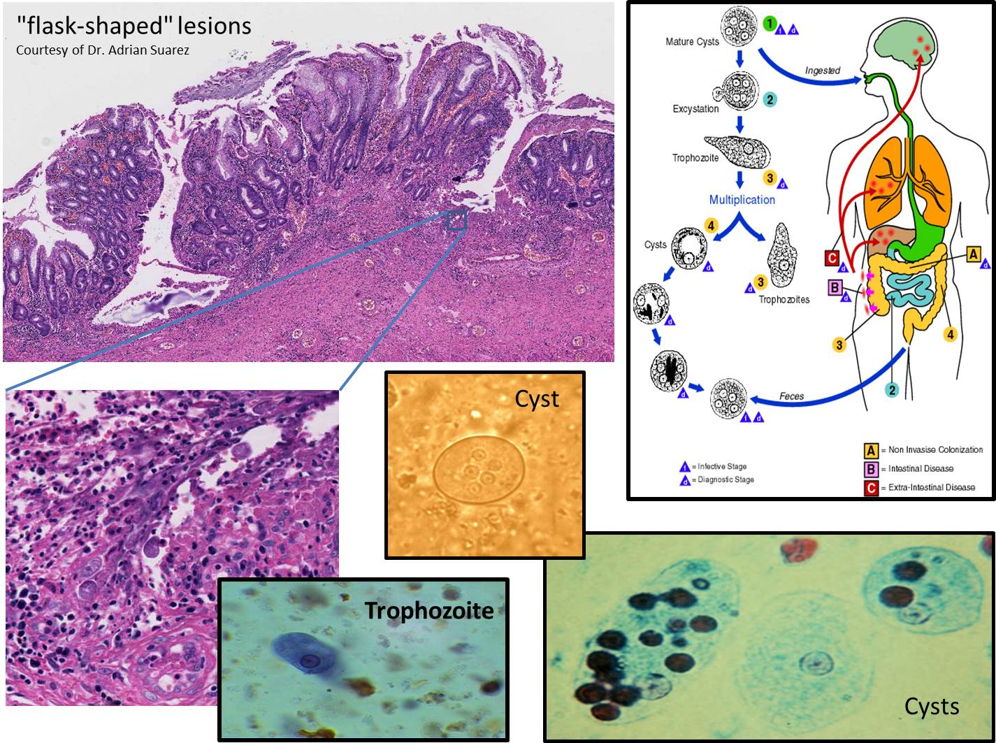 Microscopic image possibly detecting cancerous areas in human tissue