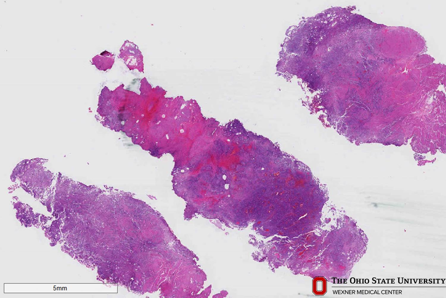 Microscopic image possibly detecting cancerous areas in human tissue