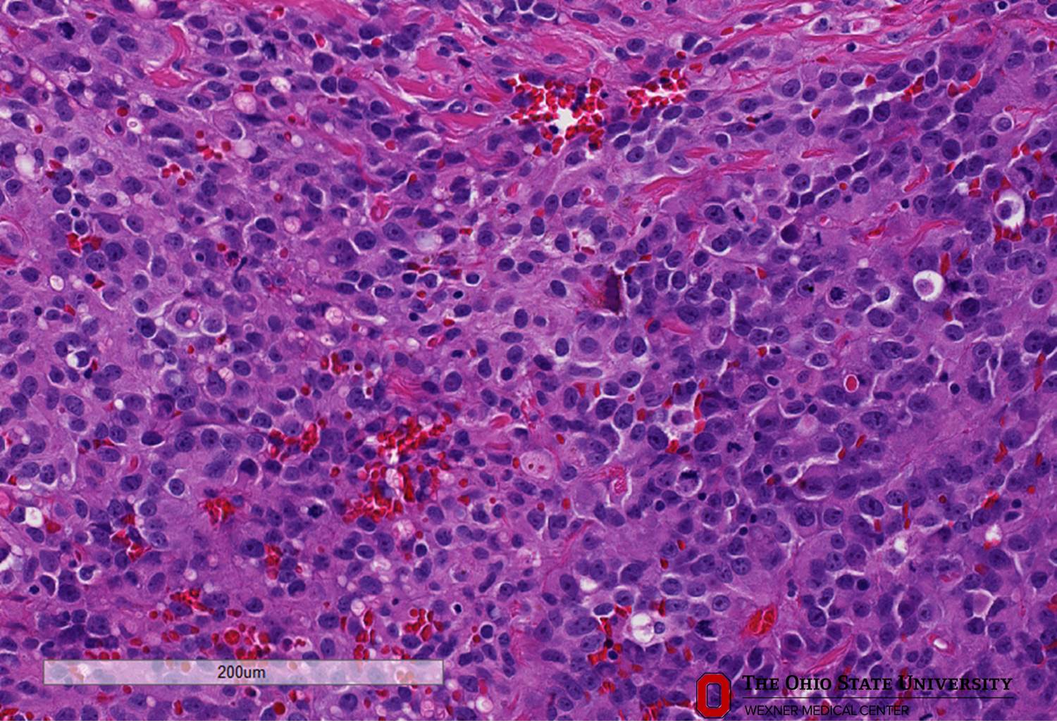 Microscopic image possibly detecting cancerous areas in human tissue