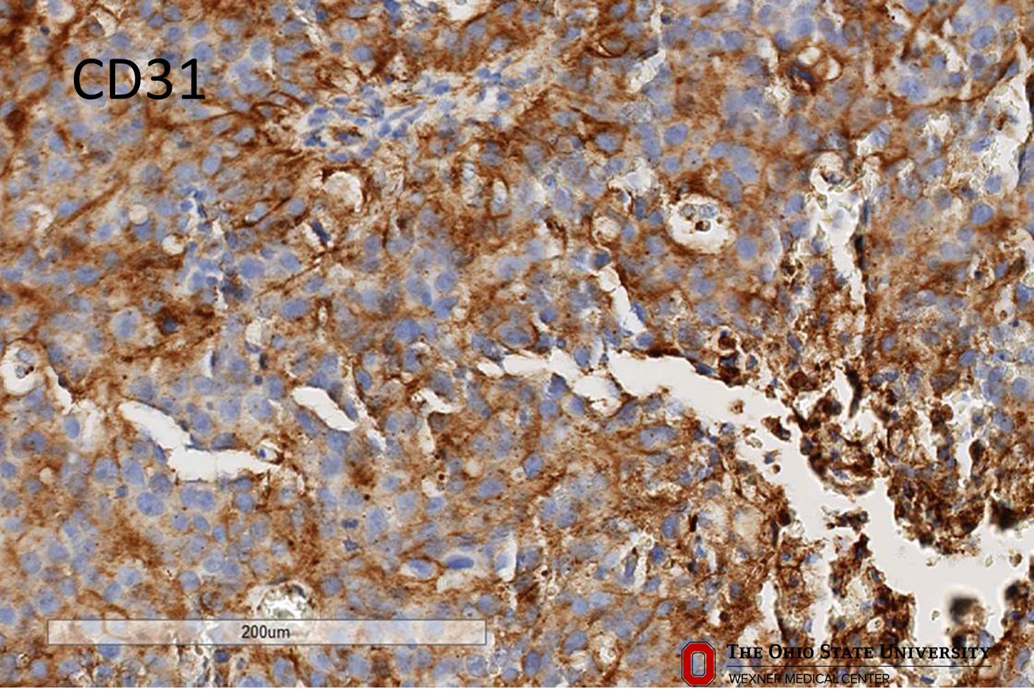 Microscopic image possibly detecting cancerous areas in human tissue