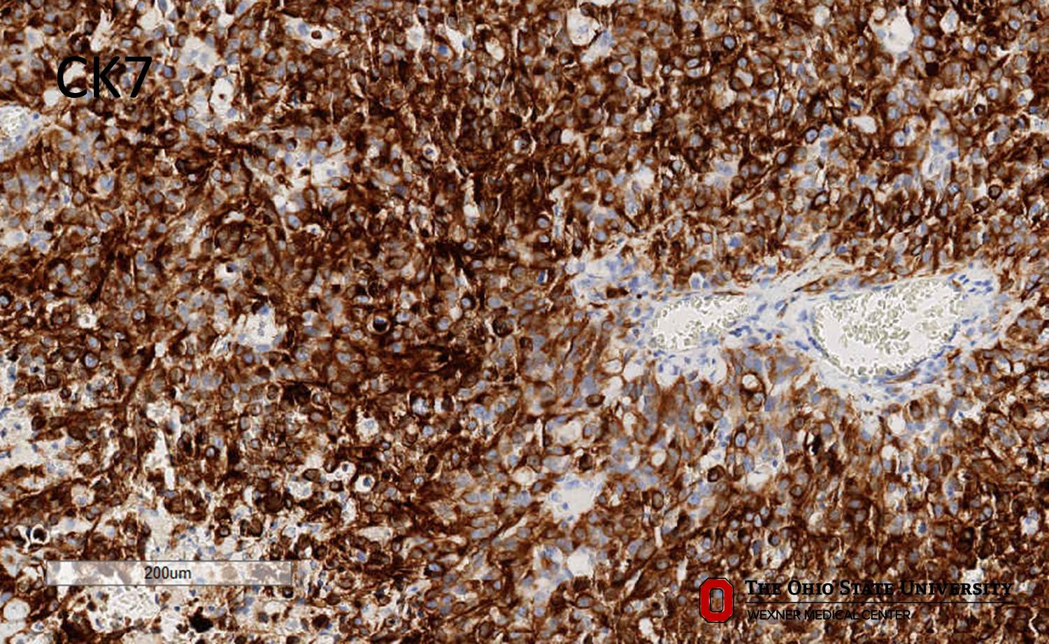 Microscopic image possibly detecting cancerous areas in human tissue