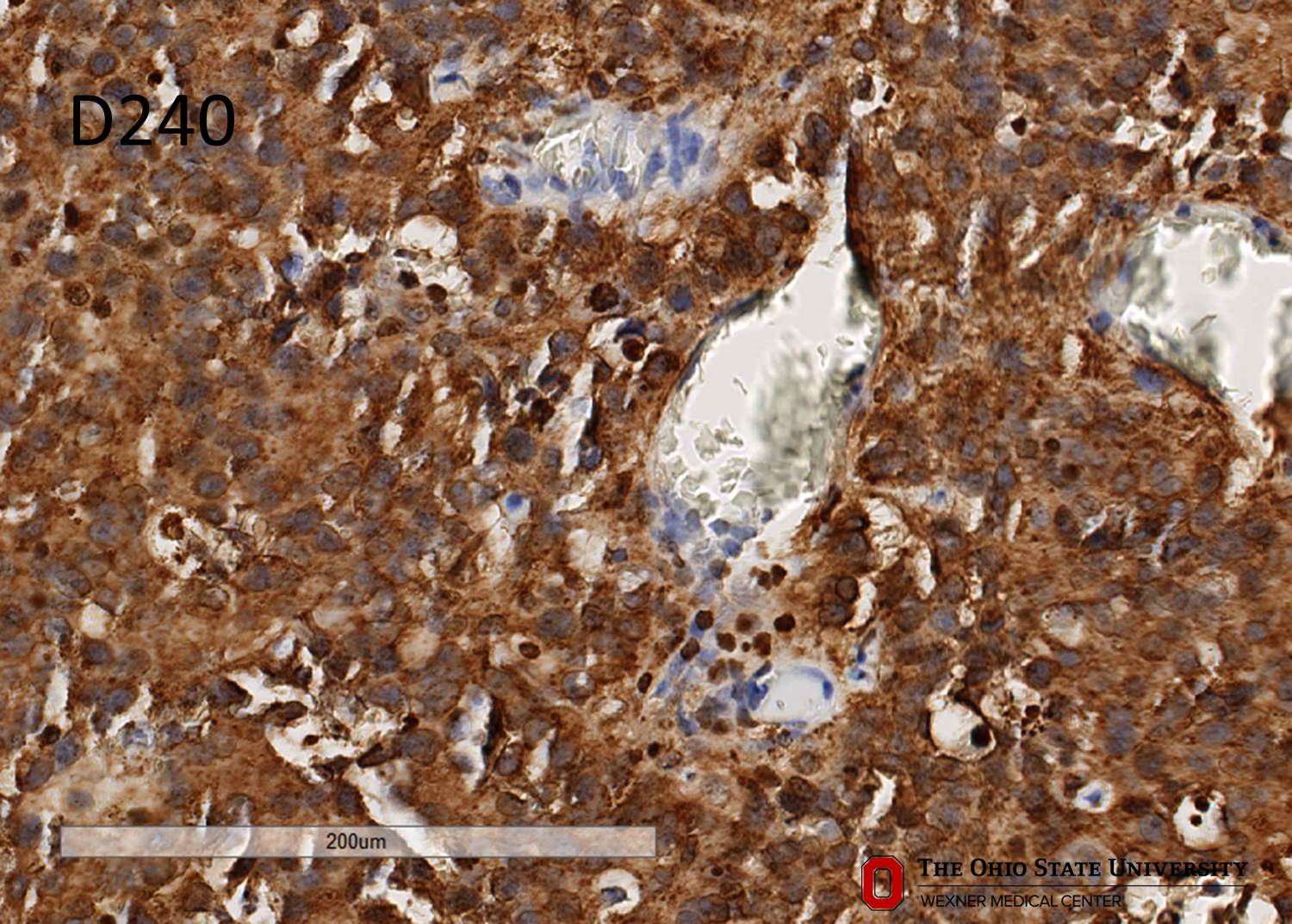 Microscopic image possibly detecting cancerous areas in human tissue