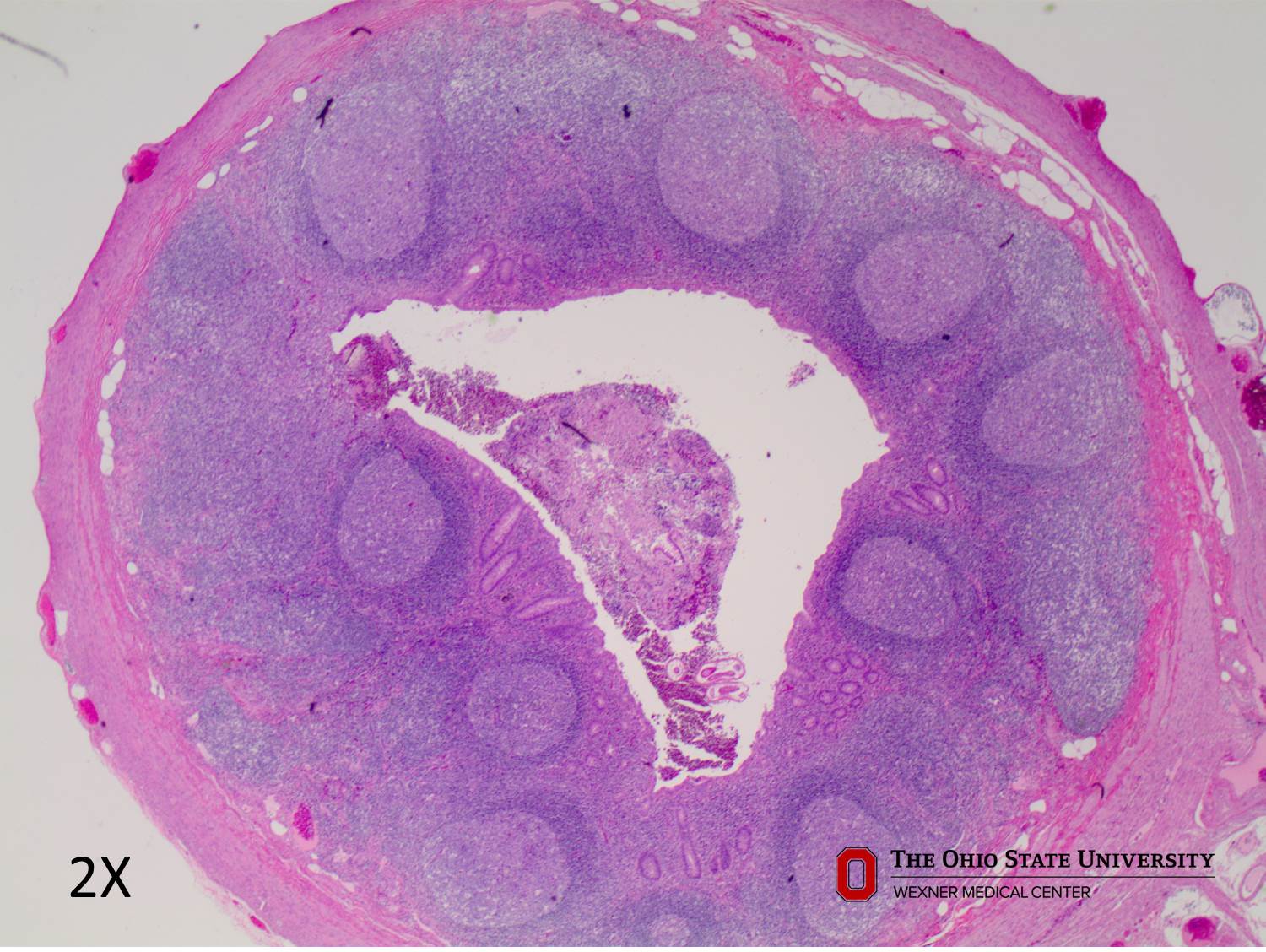 Microscopic image possibly detecting cancerous areas in human tissue