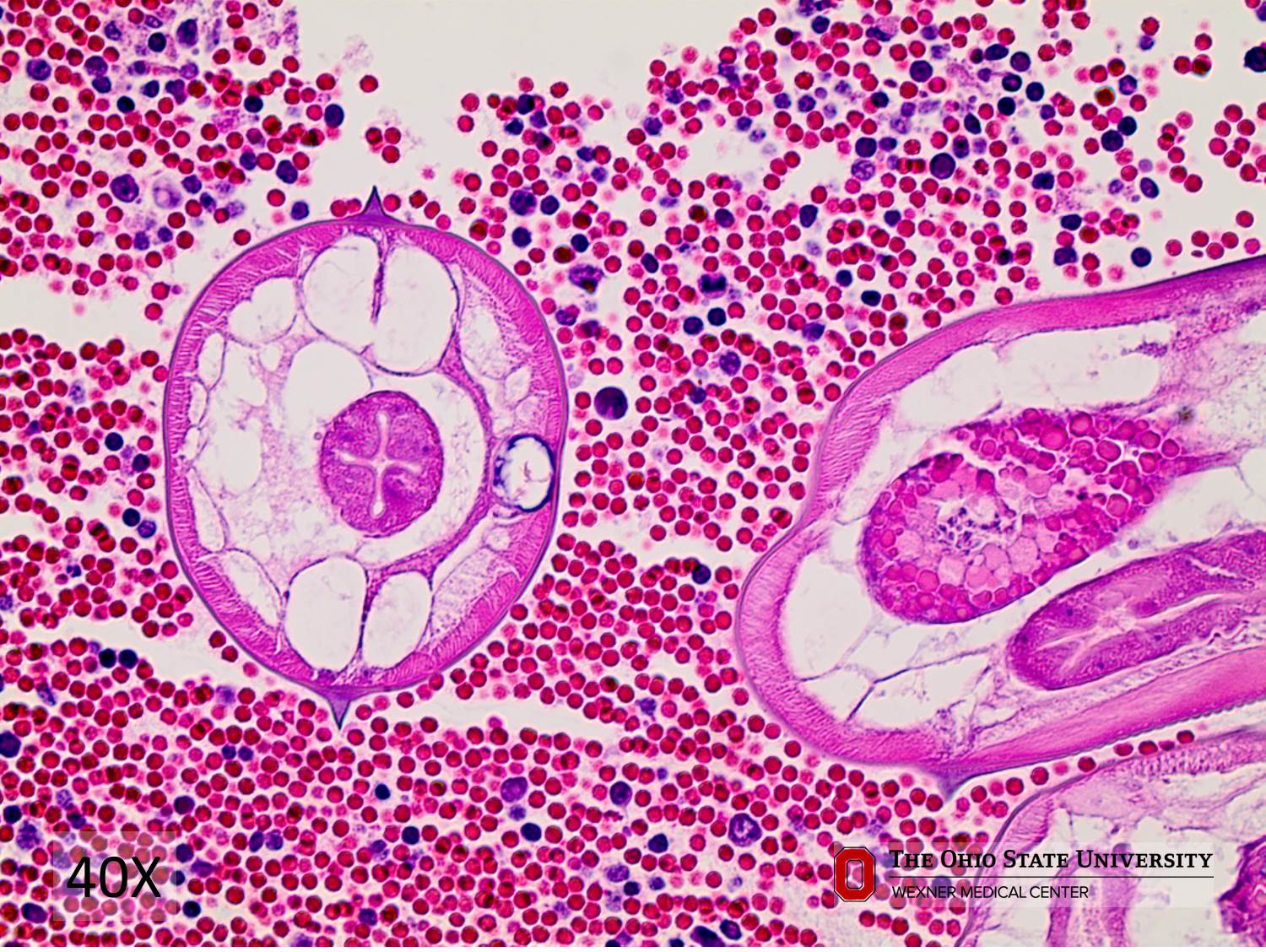 Microscopic image possibly detecting cancerous areas in human tissue