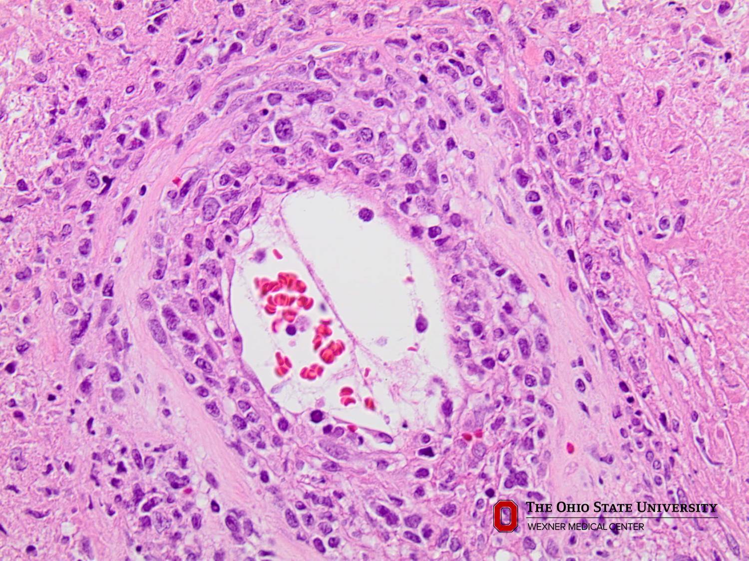 Microscopic image possibly detecting cancerous areas in human tissue