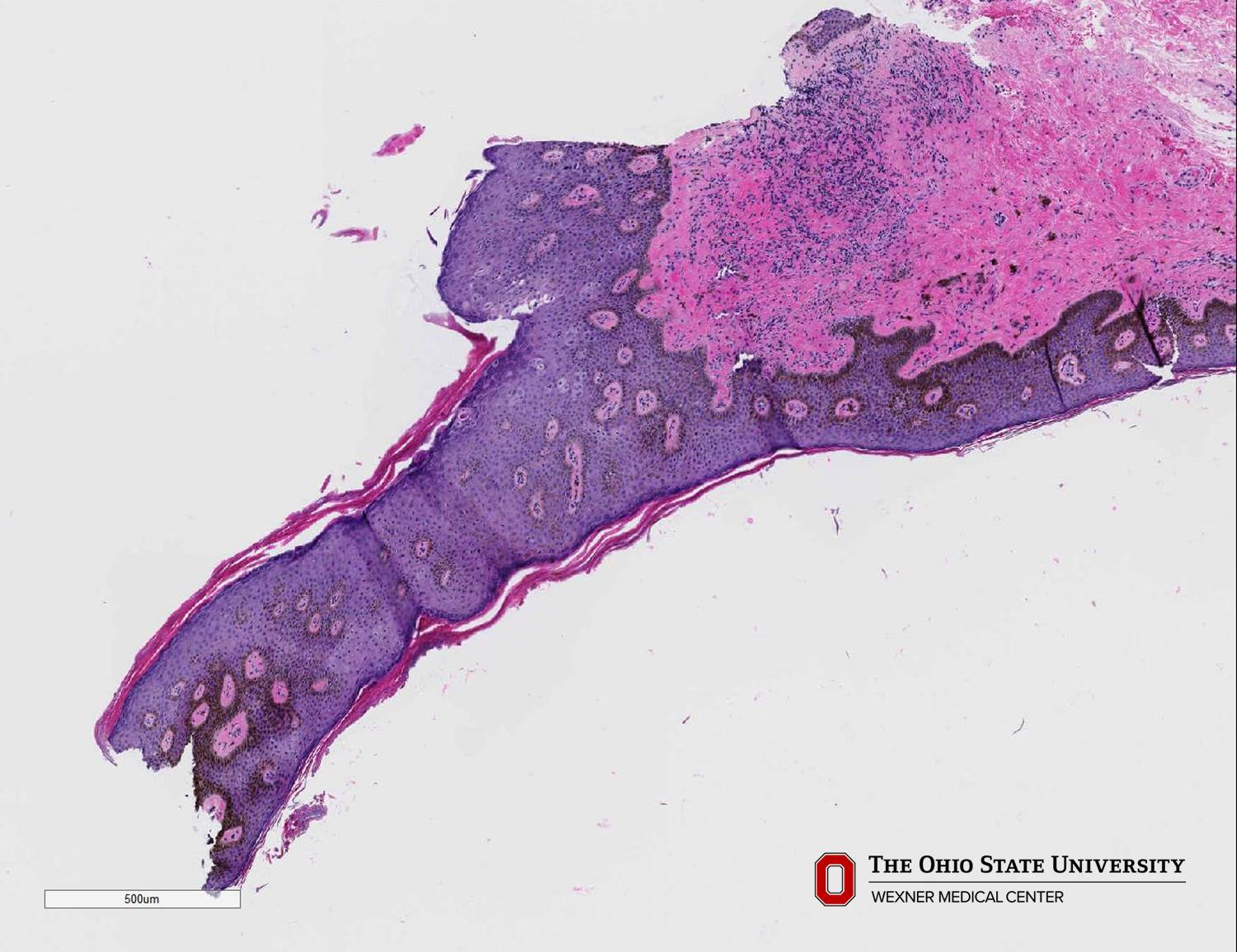 Microscopic image possibly detecting cancerous areas in human tissue