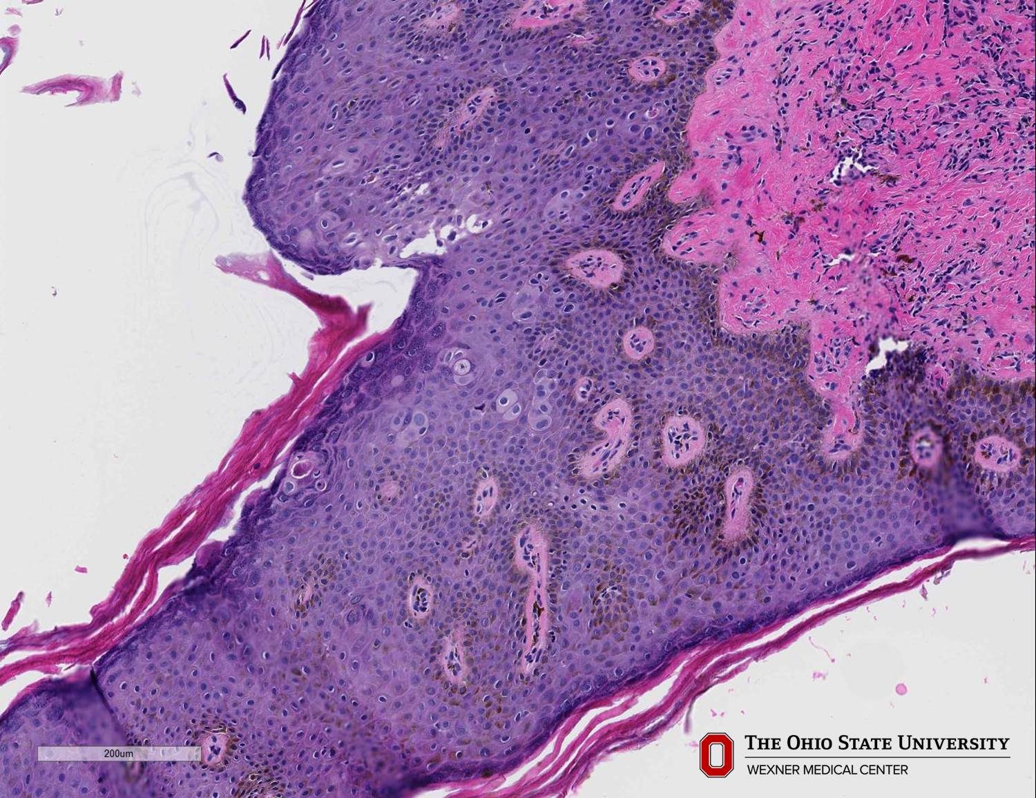 Microscopic image possibly detecting cancerous areas in human tissue