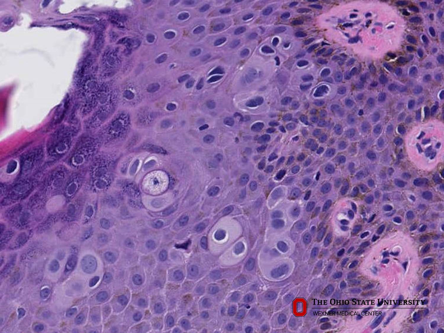 Microscopic image possibly detecting cancerous areas in human tissue