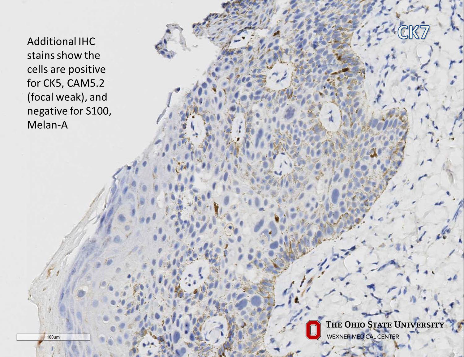 Microscopic image possibly detecting cancerous areas in human tissue