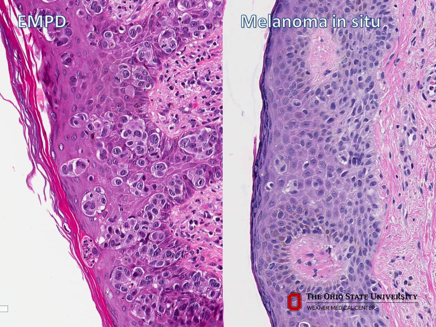 Microscopic image possibly detecting cancerous areas in human tissue