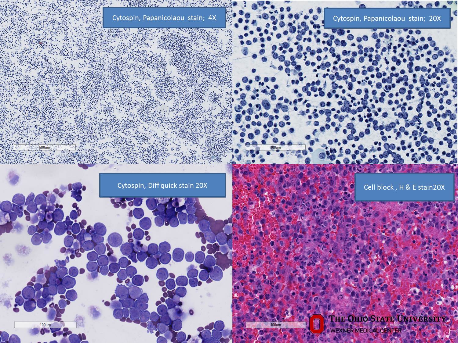 Microscopic image possibly detecting cancerous areas in human tissue