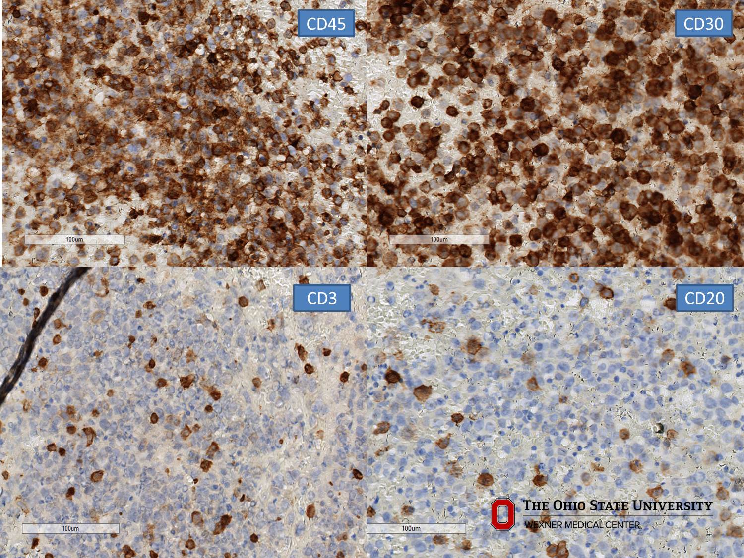 Microscopic image possibly detecting cancerous areas in human tissue