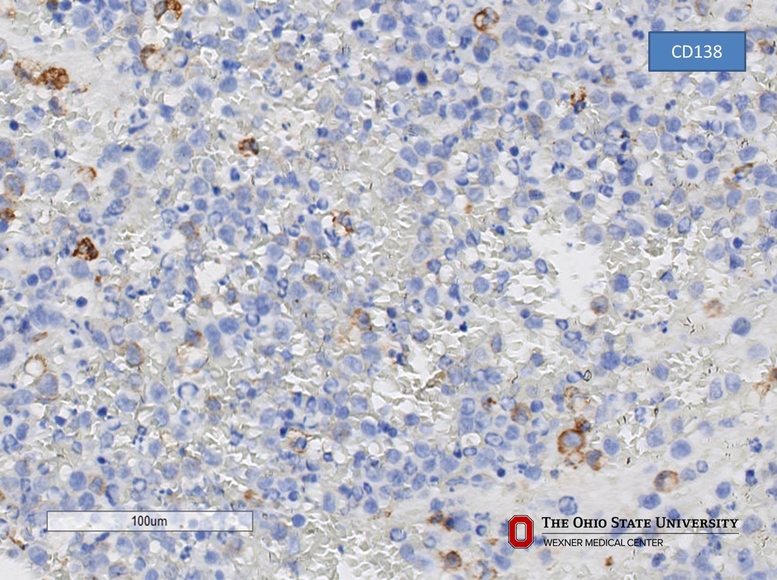 Microscopic image possibly detecting cancerous areas in human tissue