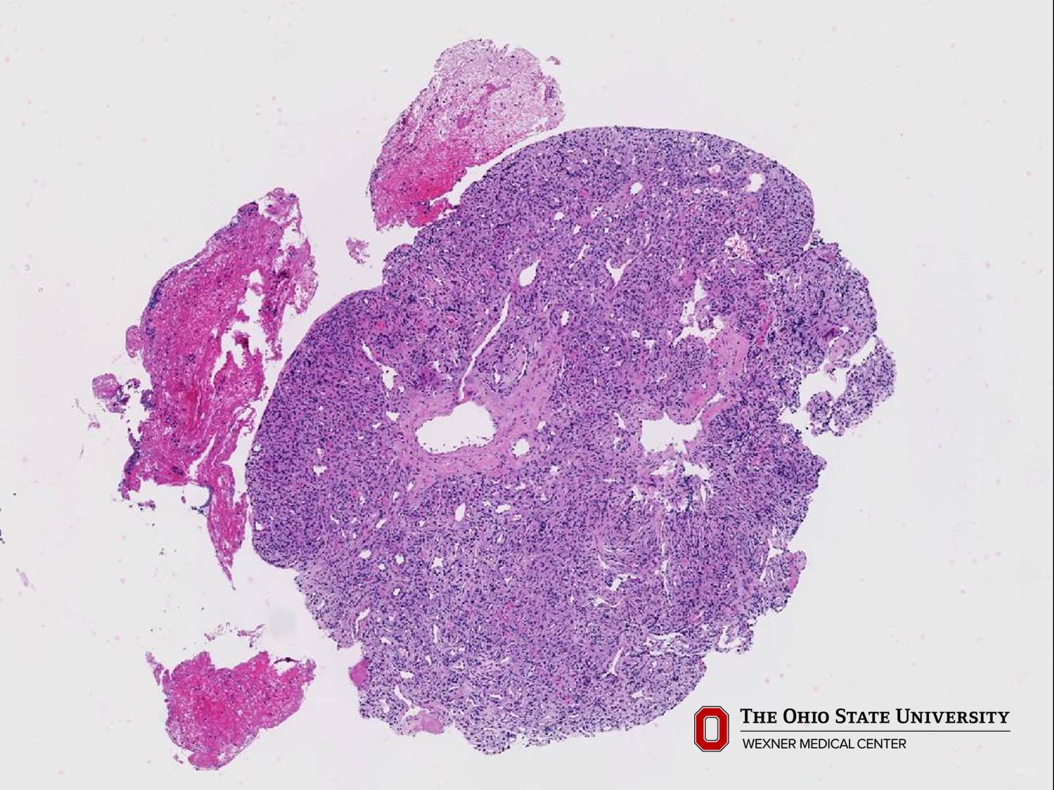 Microscopic image possibly detecting cancerous areas in human tissue