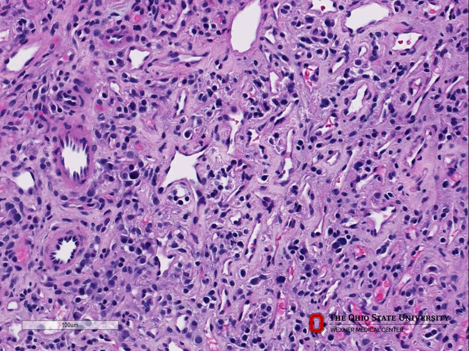 Microscopic image possibly detecting cancerous areas in human tissue