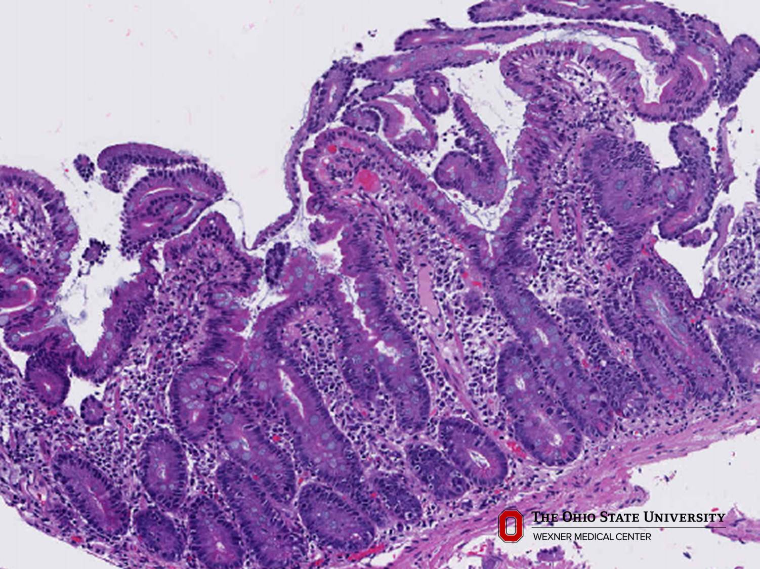 Microscopic image possibly detecting cancerous areas in human tissue