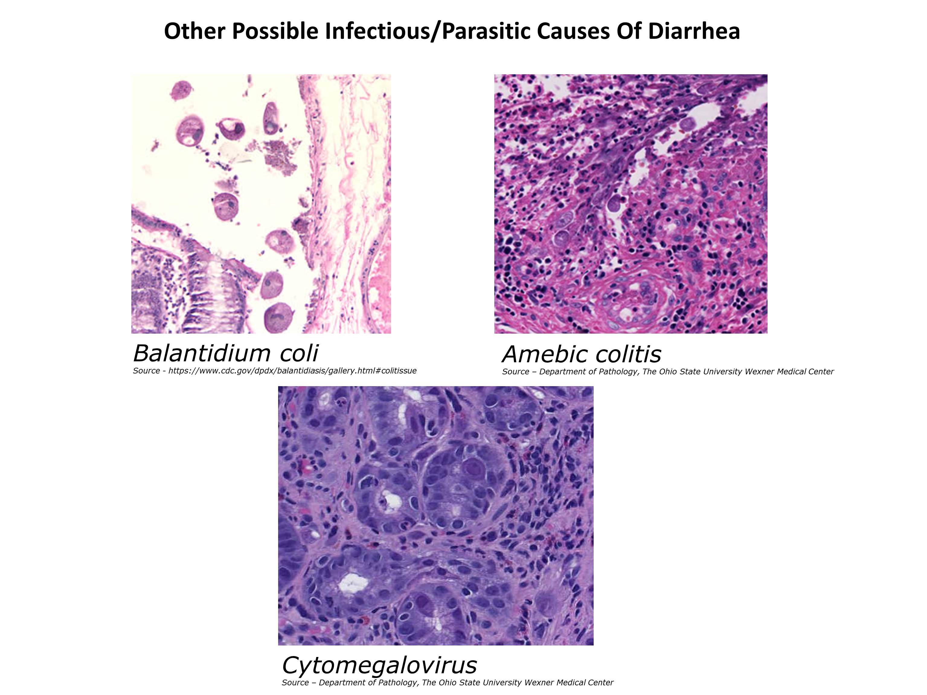 Microscopic image possibly detecting cancerous areas in human tissue