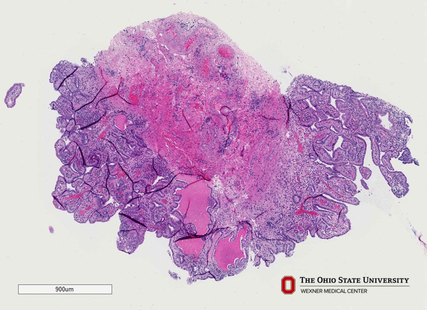 Microscopic image possibly detecting cancerous areas in human tissue