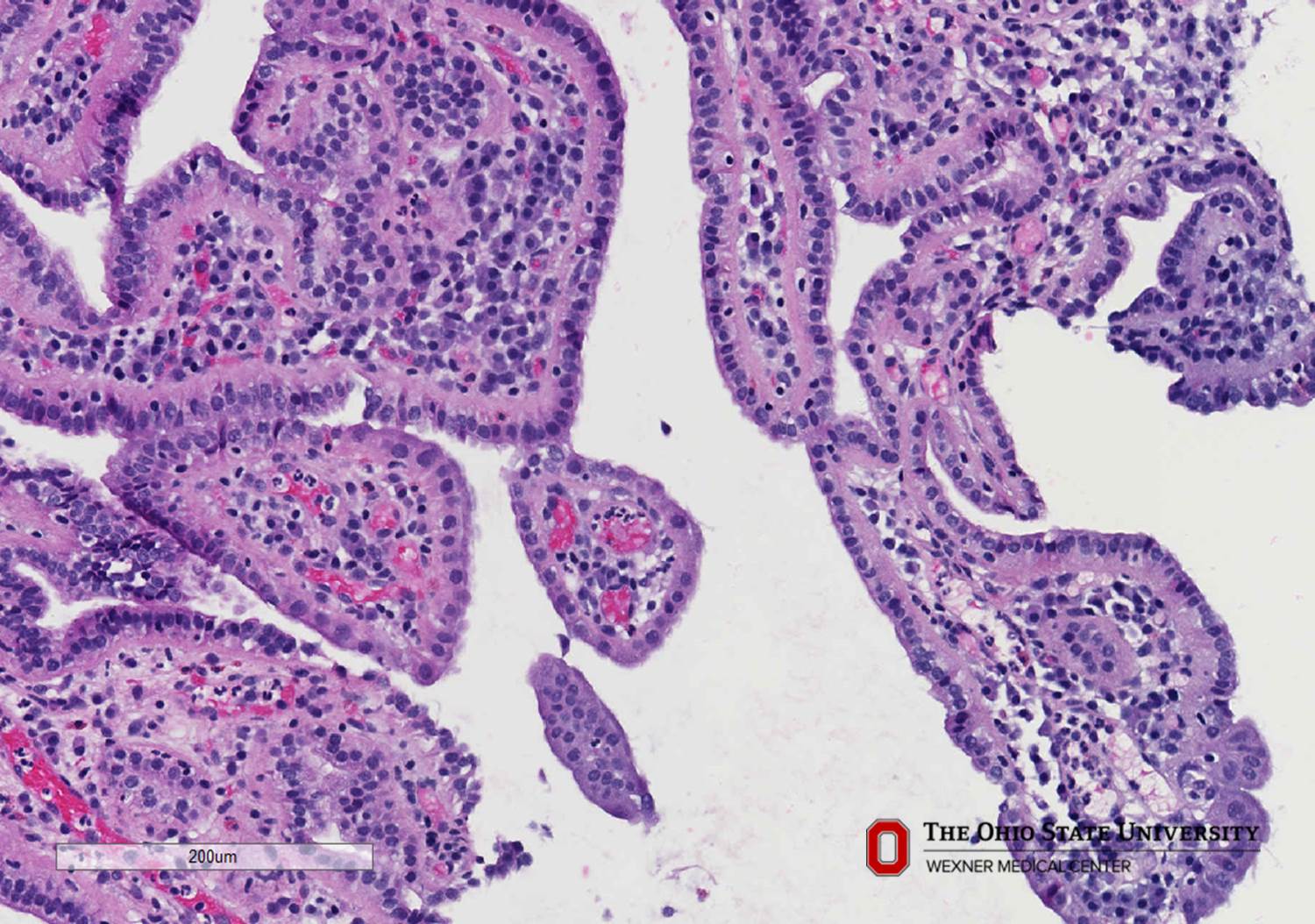 Microscopic image possibly detecting cancerous areas in human tissue