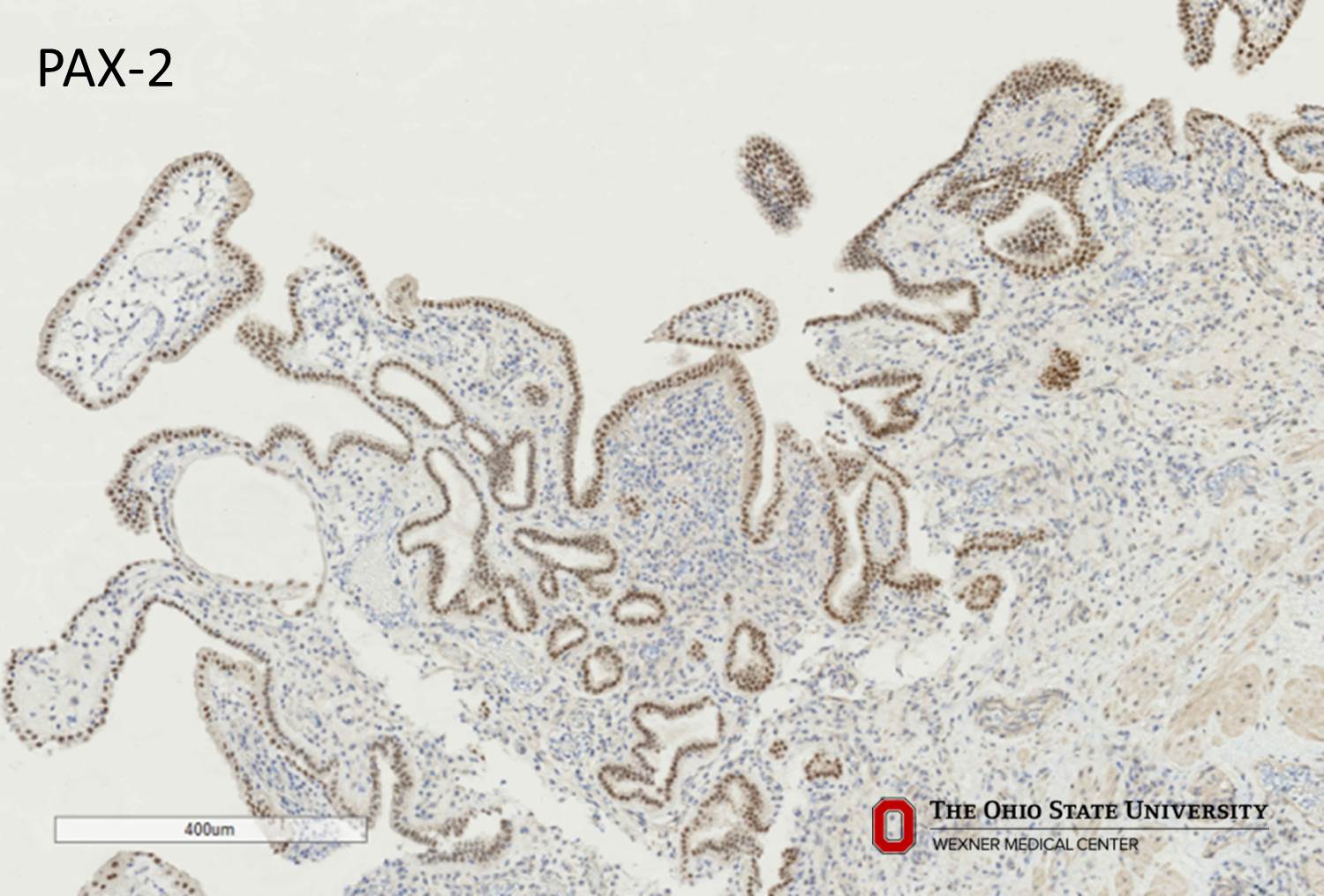 Microscopic image possibly detecting cancerous areas in human tissue