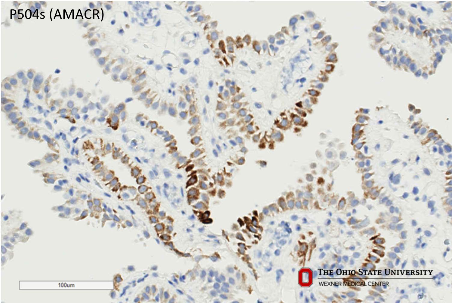 Microscopic image possibly detecting cancerous areas in human tissue