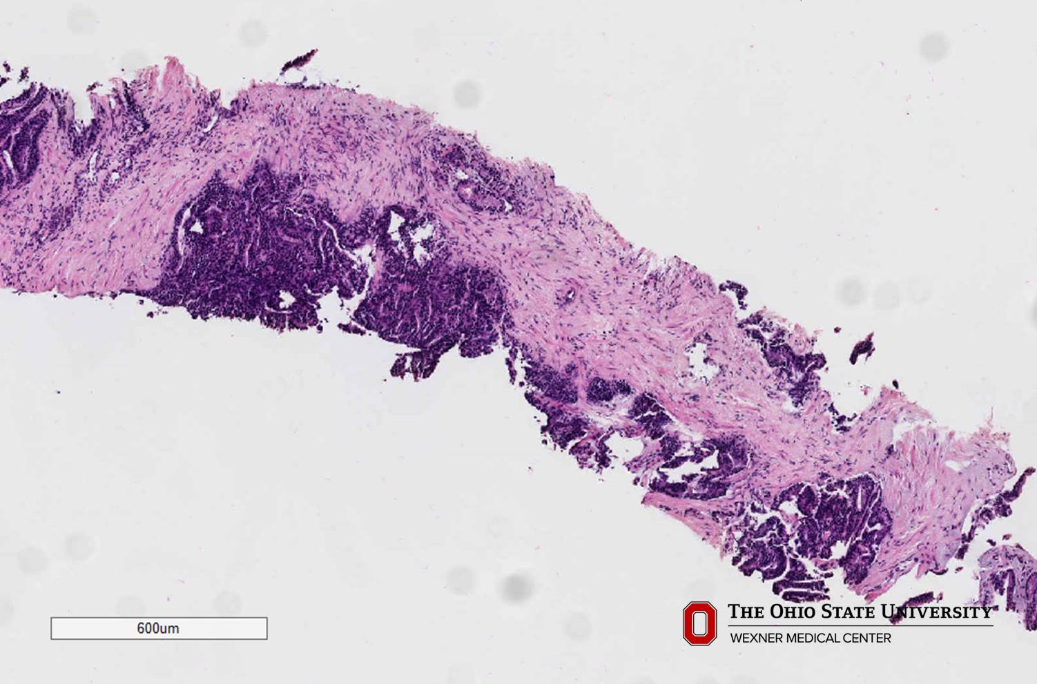 Microscopic image possibly detecting cancerous areas in human tissue