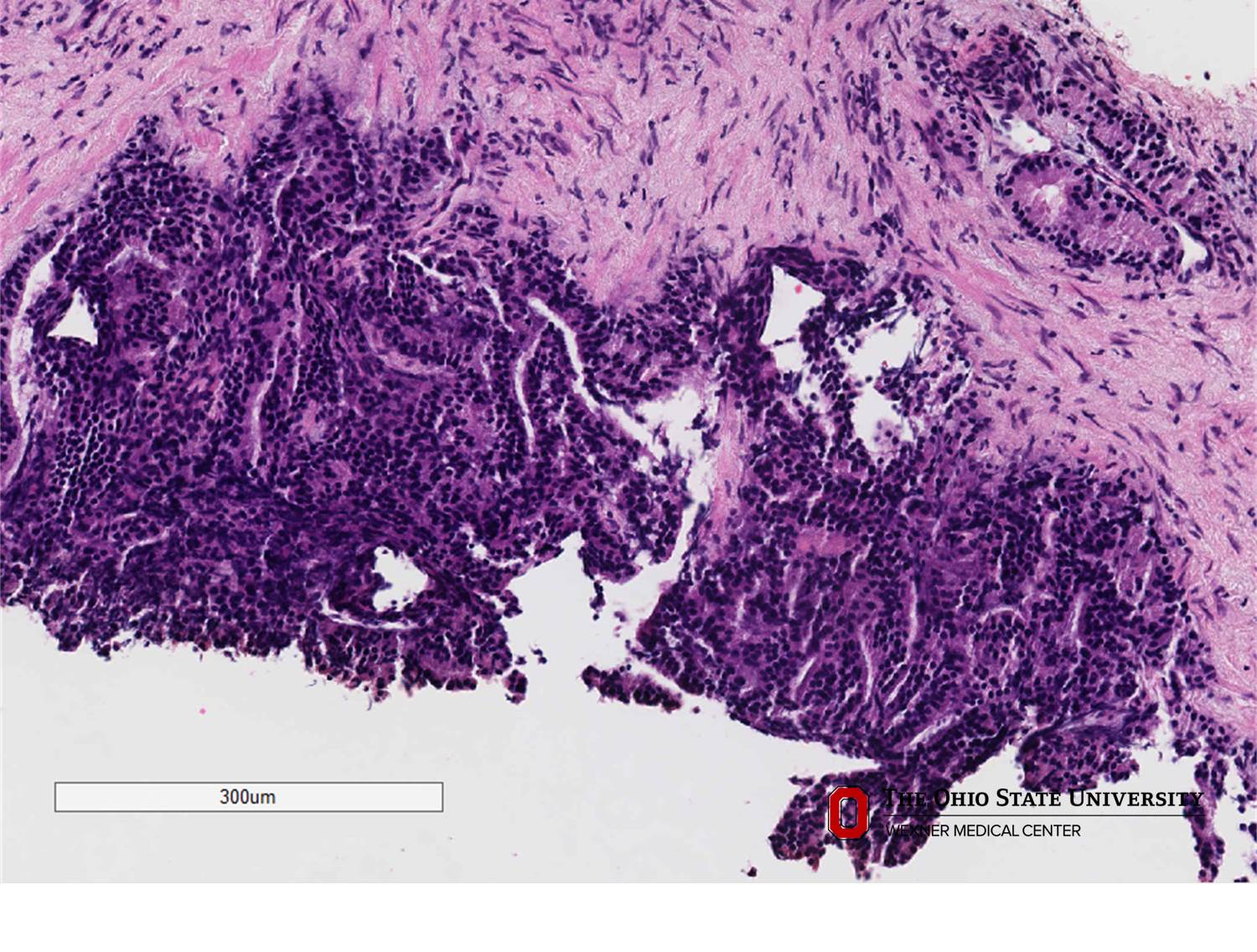 Microscopic image possibly detecting cancerous areas in human tissue