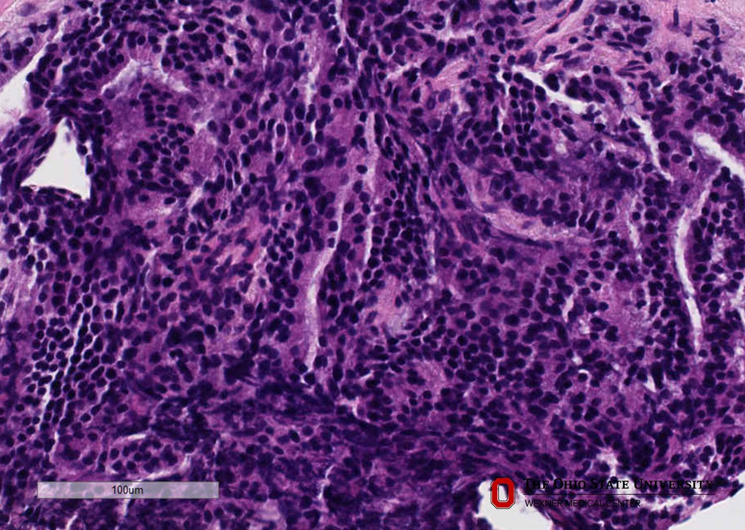 Microscopic image possibly detecting cancerous areas in human tissue