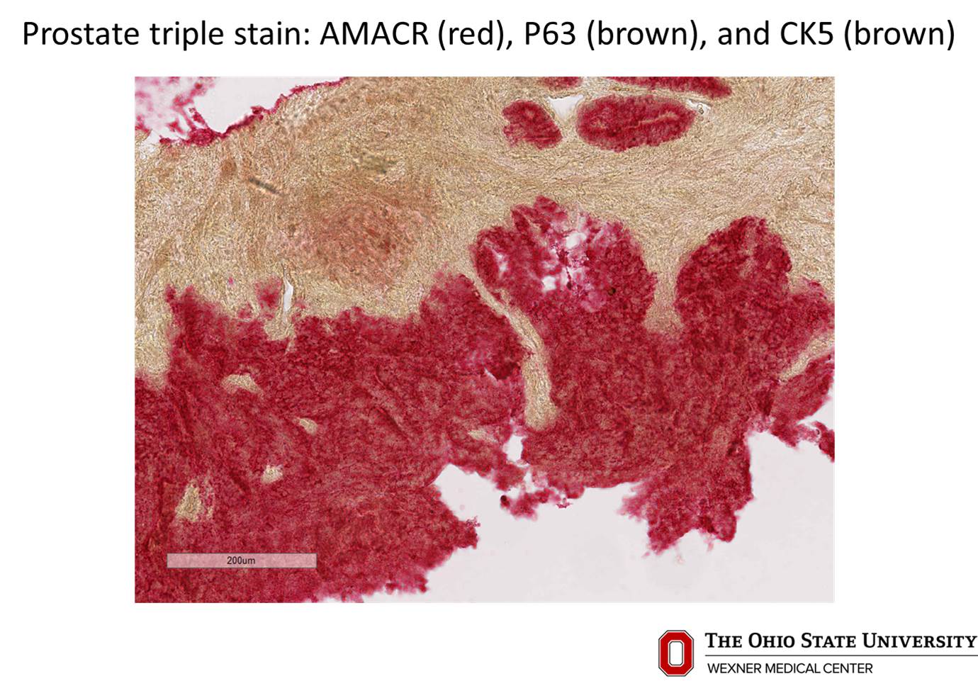 Microscopic image possibly detecting cancerous areas in human tissue