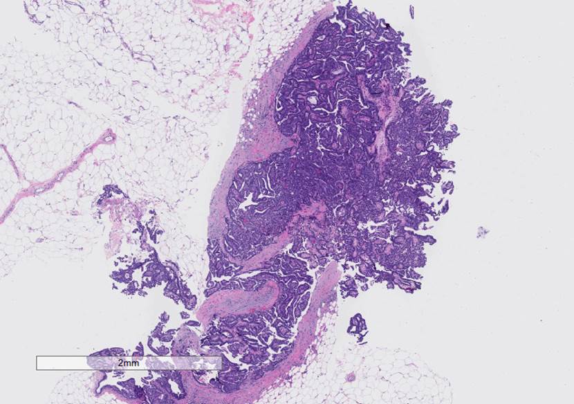 Microscopic image possibly detecting cancerous areas in human tissue