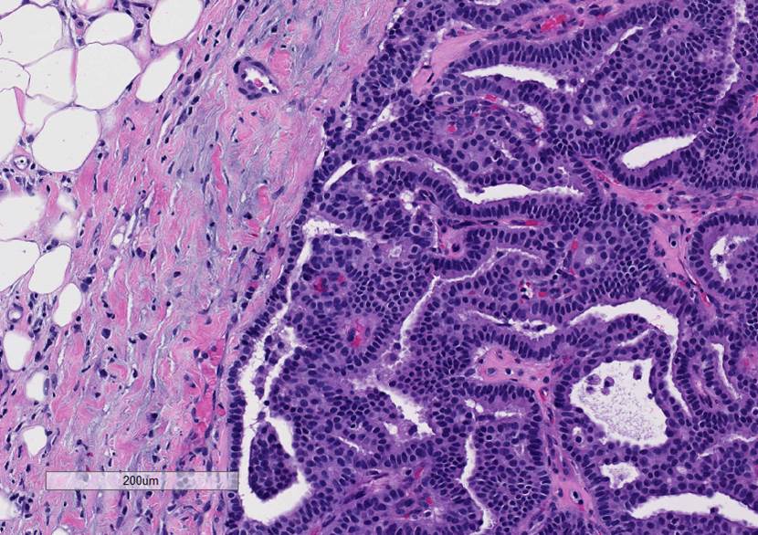 Microscopic image possibly detecting cancerous areas in human tissue