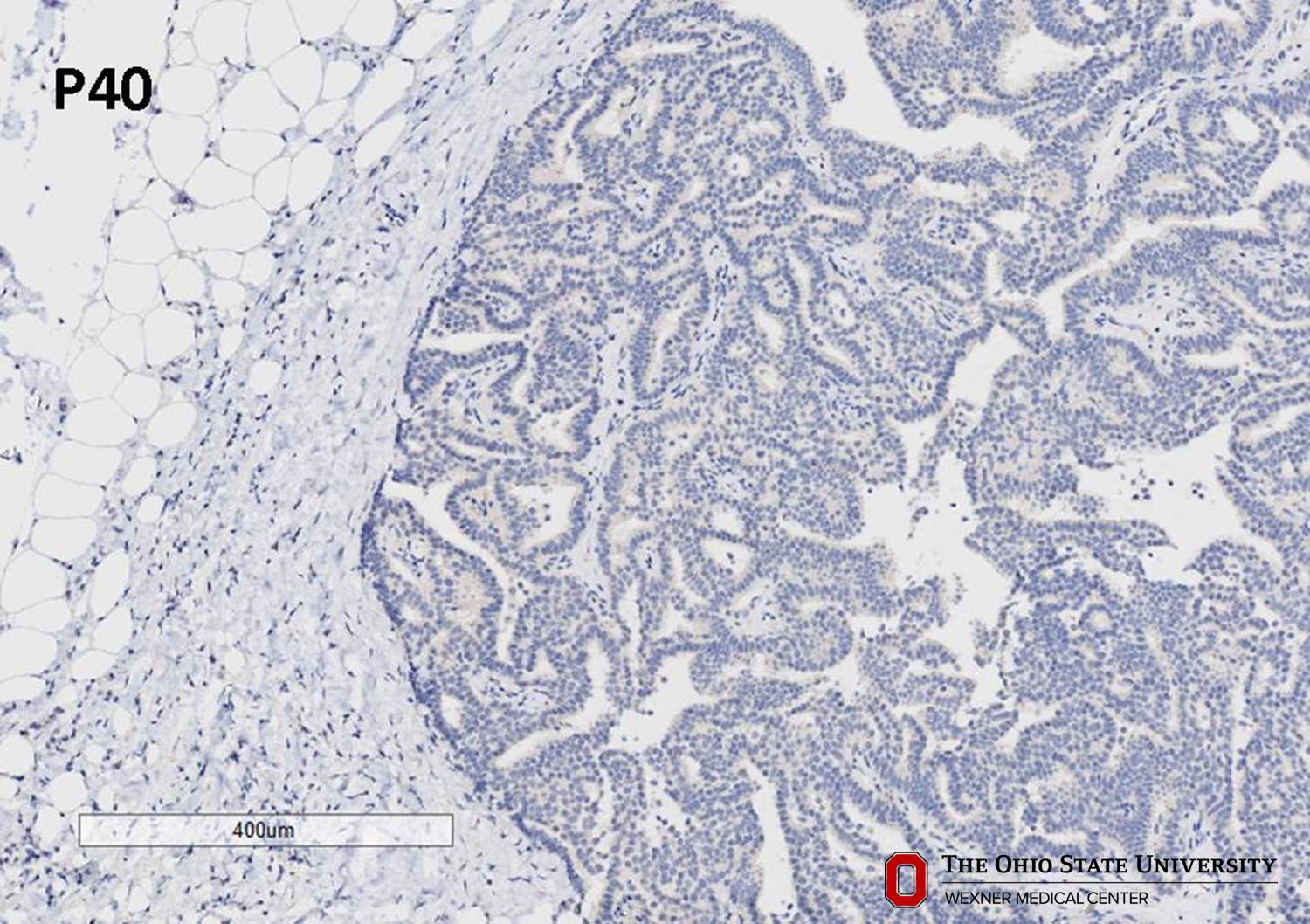 Microscopic image possibly detecting cancerous areas in human tissue