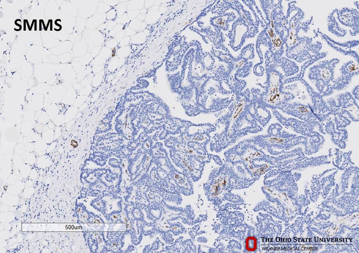 Microscopic image possibly detecting cancerous areas in human tissue