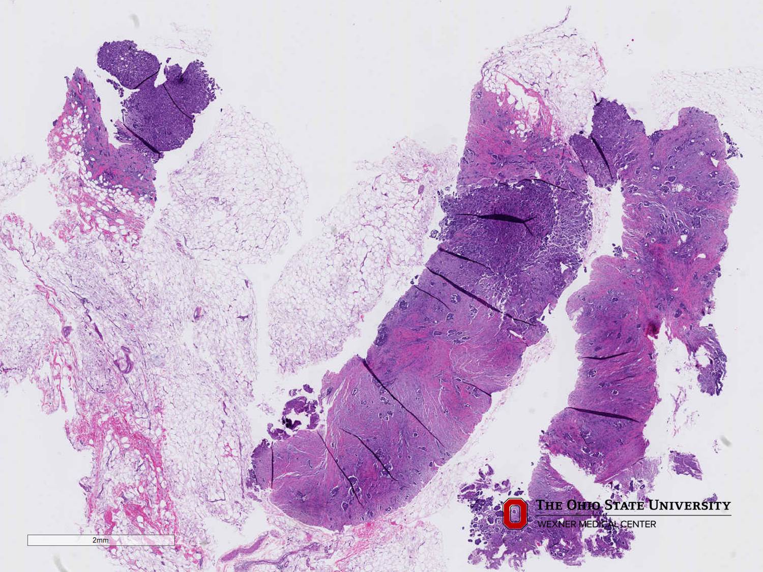 Microscopic image possibly detecting cancerous areas in human tissue