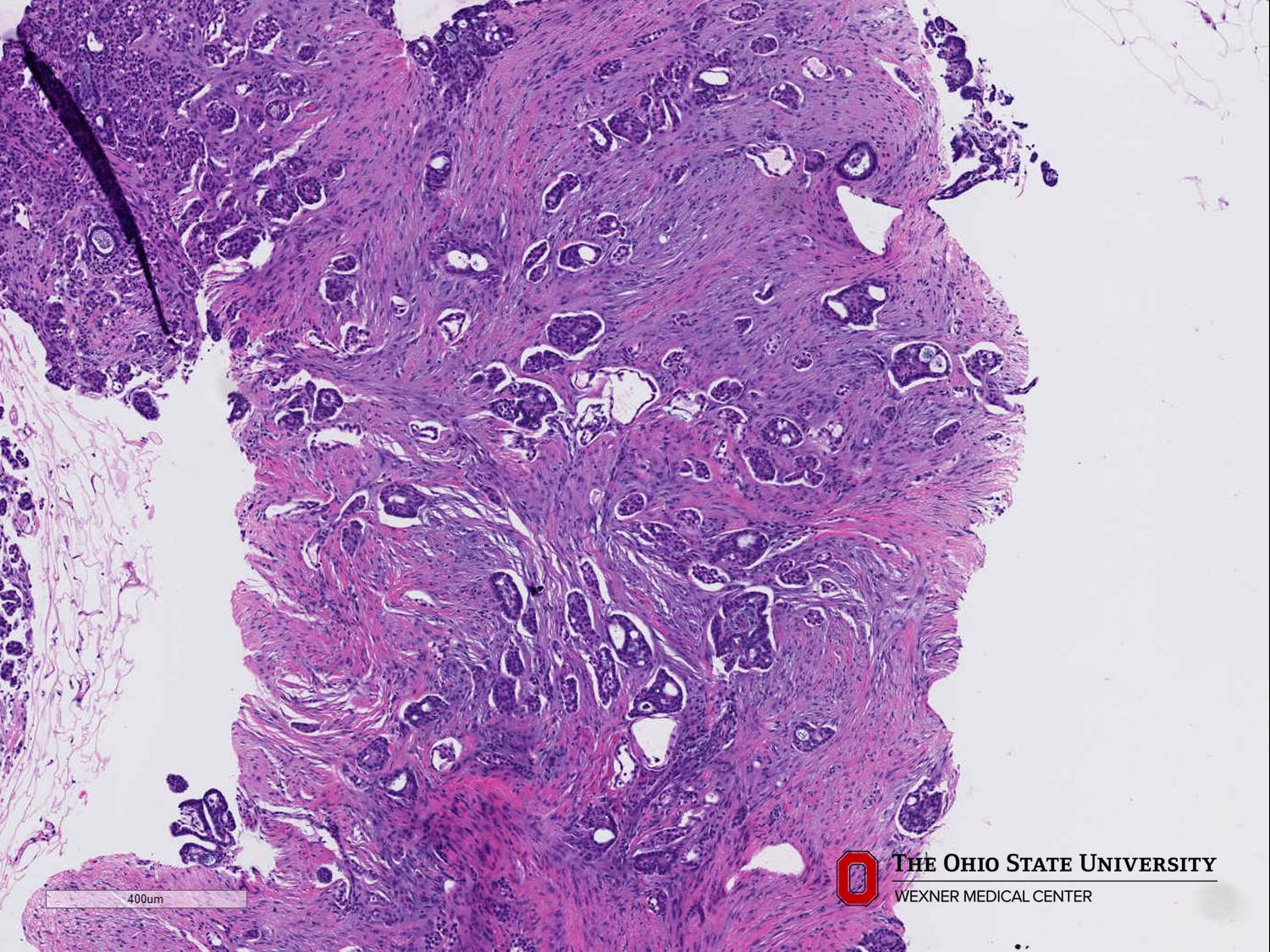 Microscopic image possibly detecting cancerous areas in human tissue