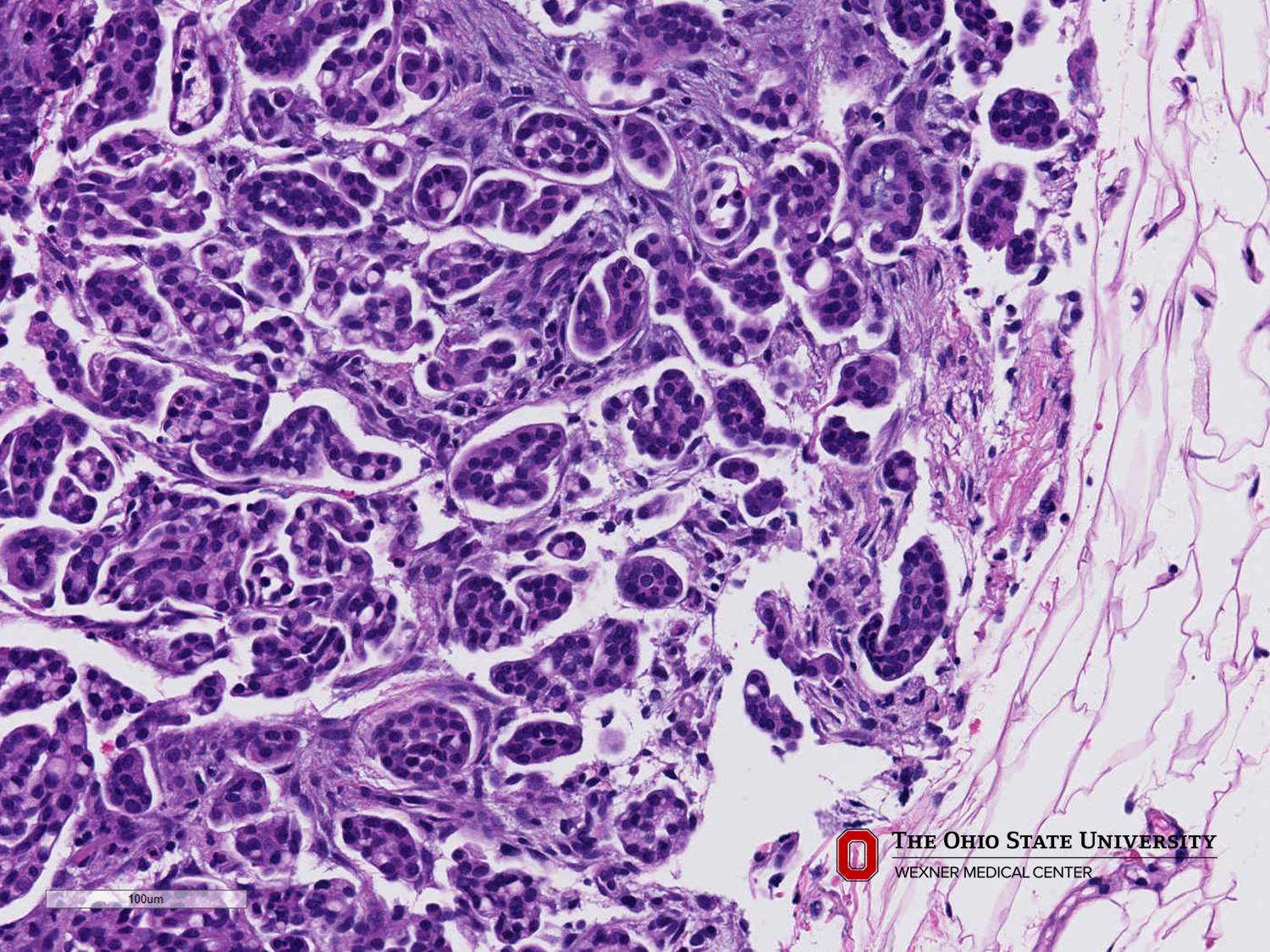 Microscopic image possibly detecting cancerous areas in human tissue