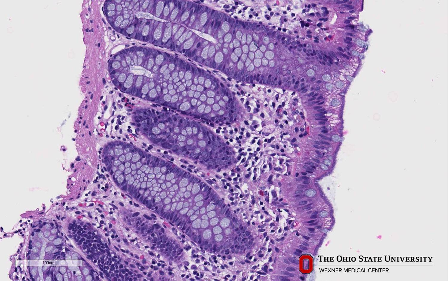 Microscopic image possibly detecting cancerous areas in human tissue