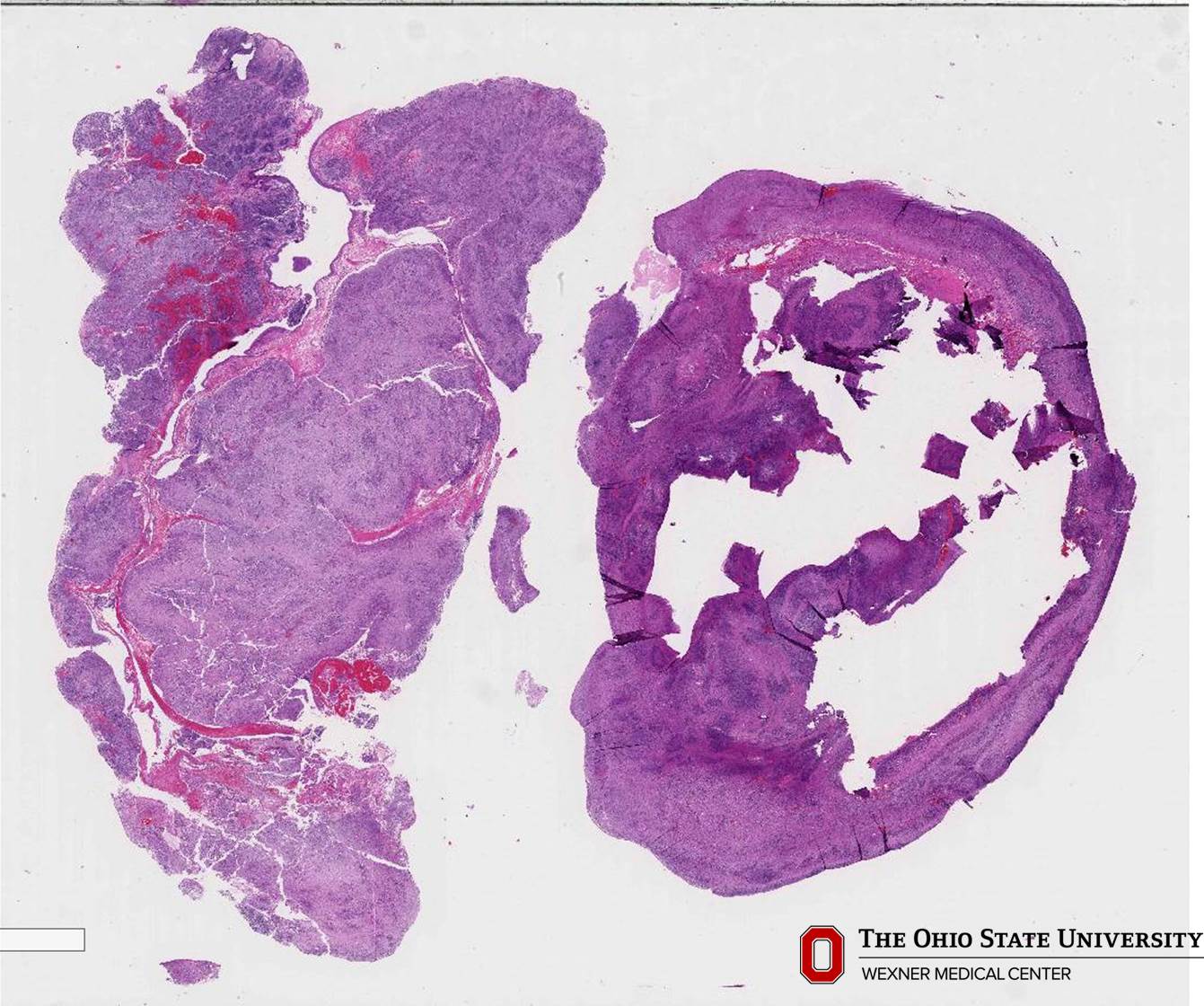 Microscopic image possibly detecting cancerous areas in human tissue