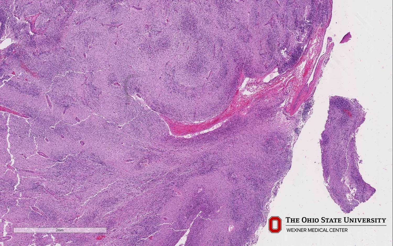 Microscopic image possibly detecting cancerous areas in human tissue