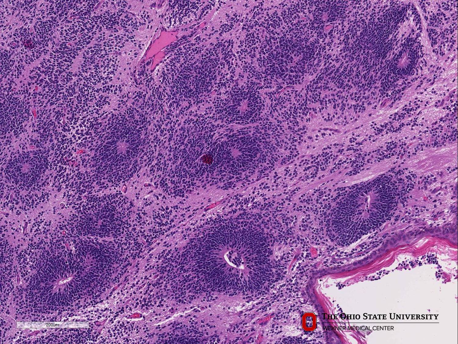 Microscopic image possibly detecting cancerous areas in human tissue